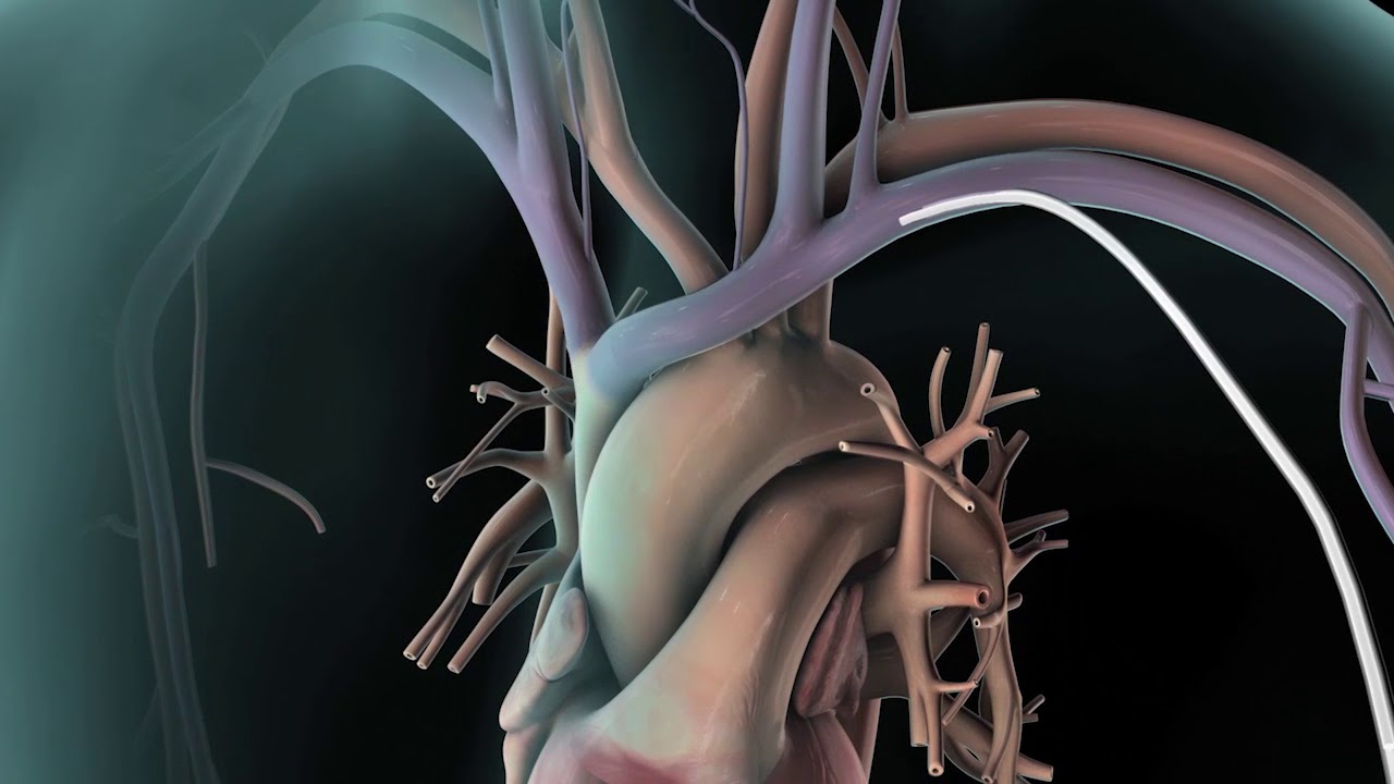 CAIAZ Desfibrilador Cardioversor Implantable ICD