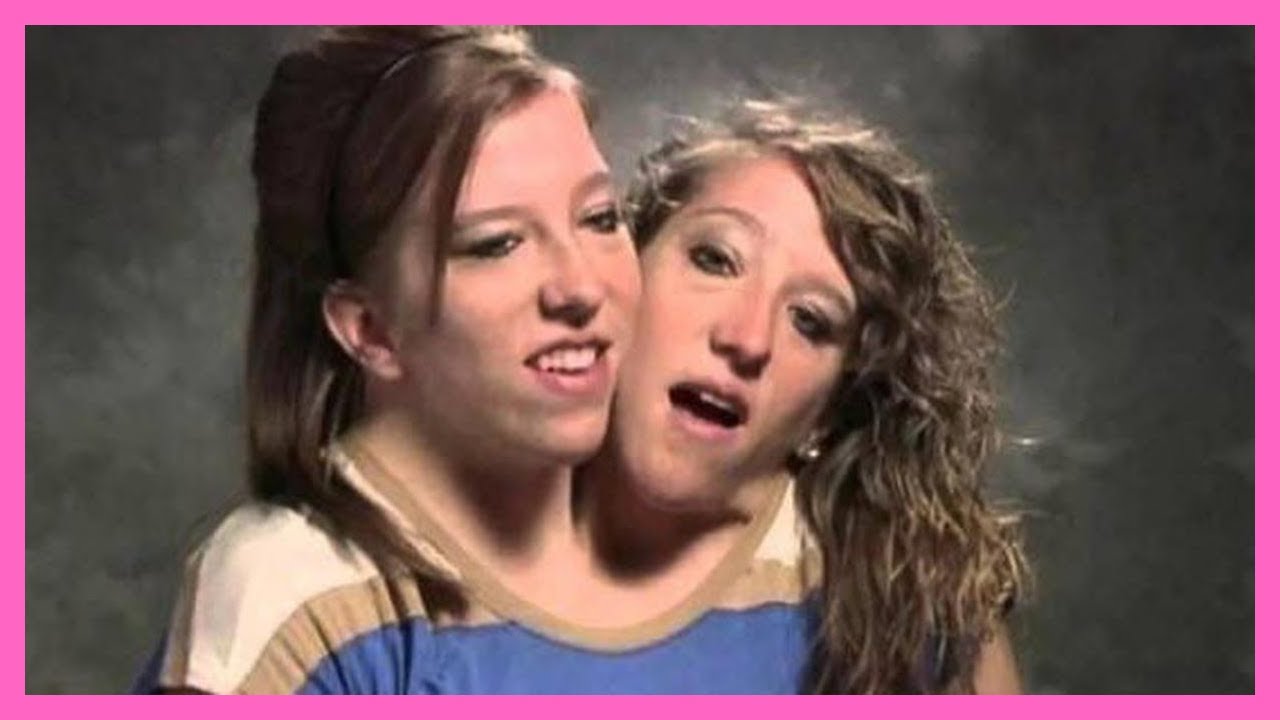 Top 10 Interesting Stories Of Conjoined Twins