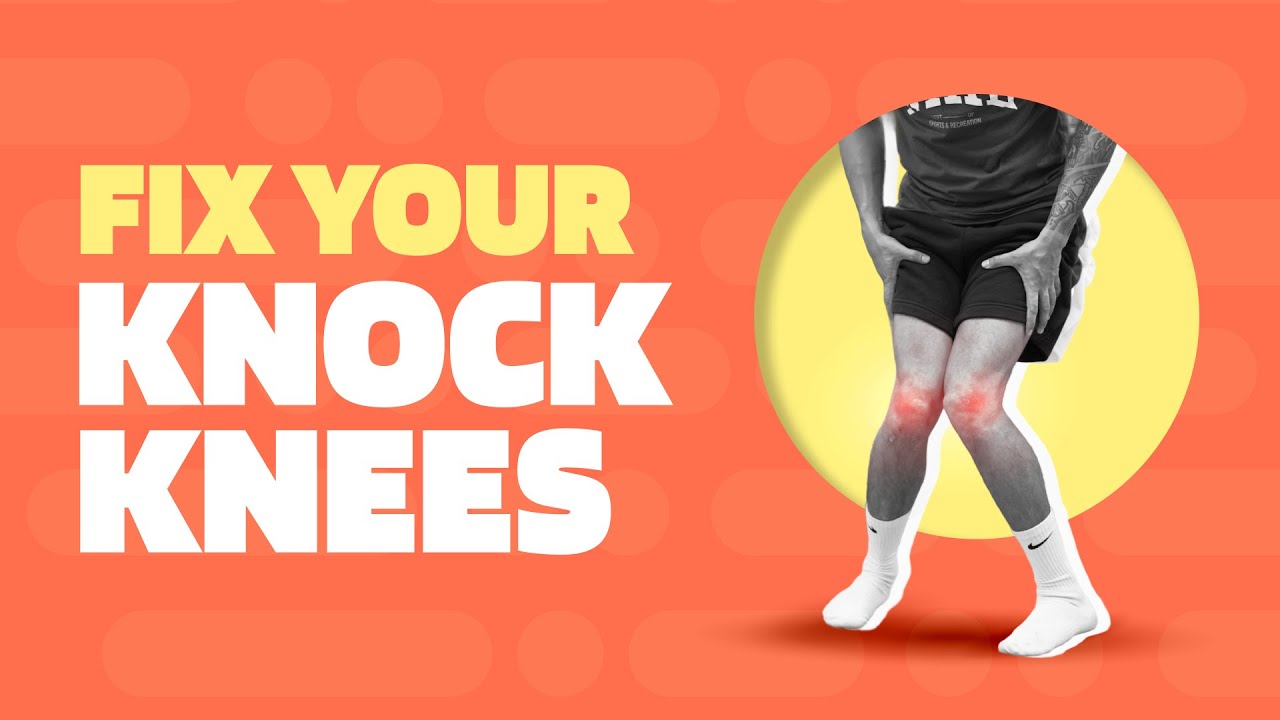 How To Fix Knock Knees (Exercises To Correct Knee Valgus)