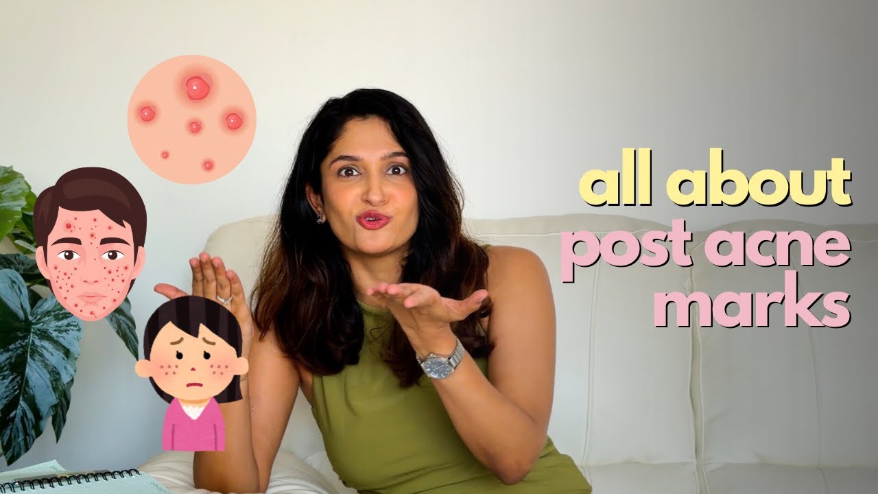 Post Acne Marks: Why they happen and How to Treat Pigmentation and Redness 
