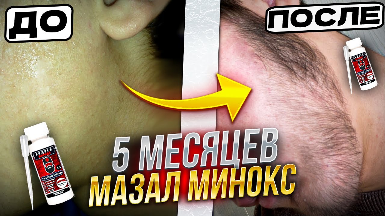 Начал мазать Минокс на бороду что со мной стало? / Андрей Борода / Выпуск №20