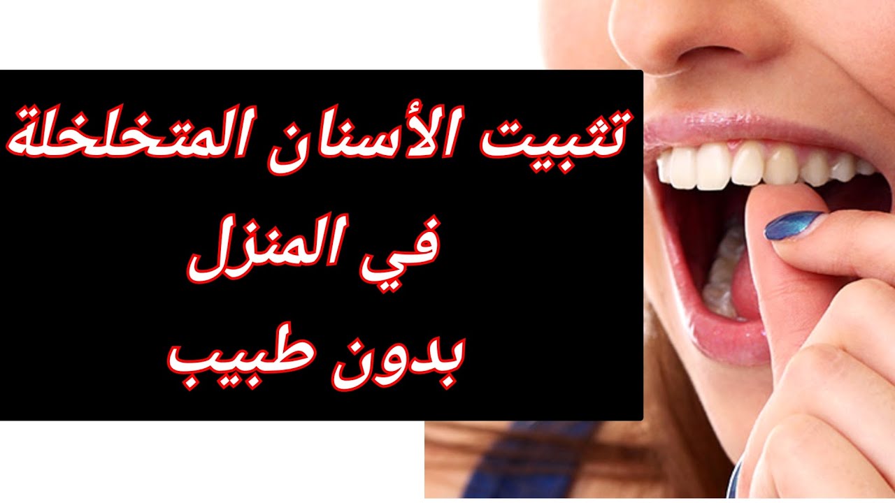 كيفية تثبيت الأسنان المتخلخلة في المنزل بدون طبيب