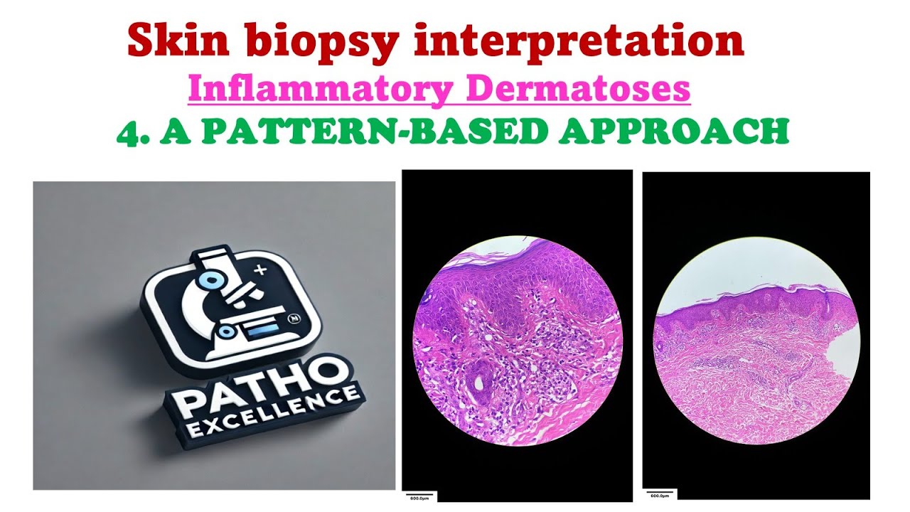 Skin Biopsy Interpretation: Inflammatory Dermatoses | Pattern-Based Approach | Ep 4