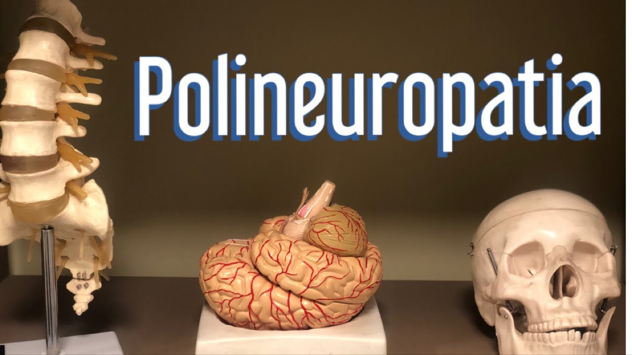 Polineuropatia