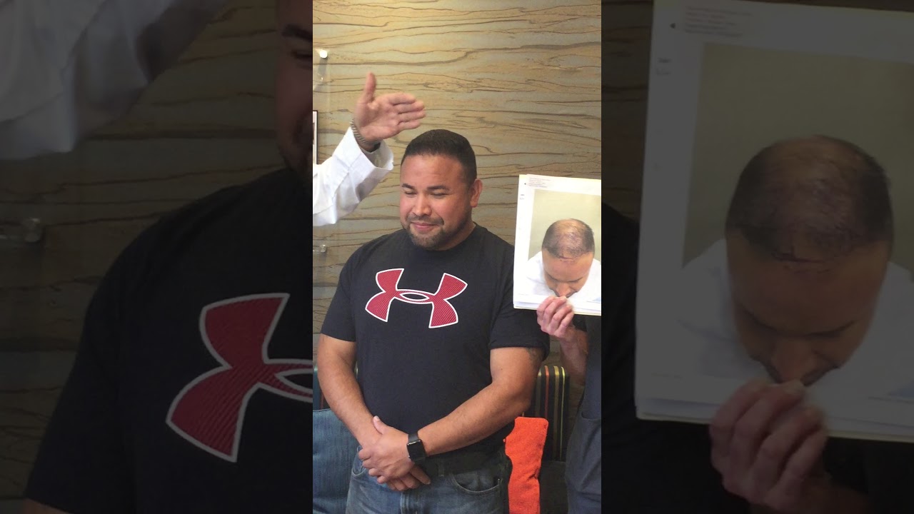 Dr. Yates FUE Hair Transplant