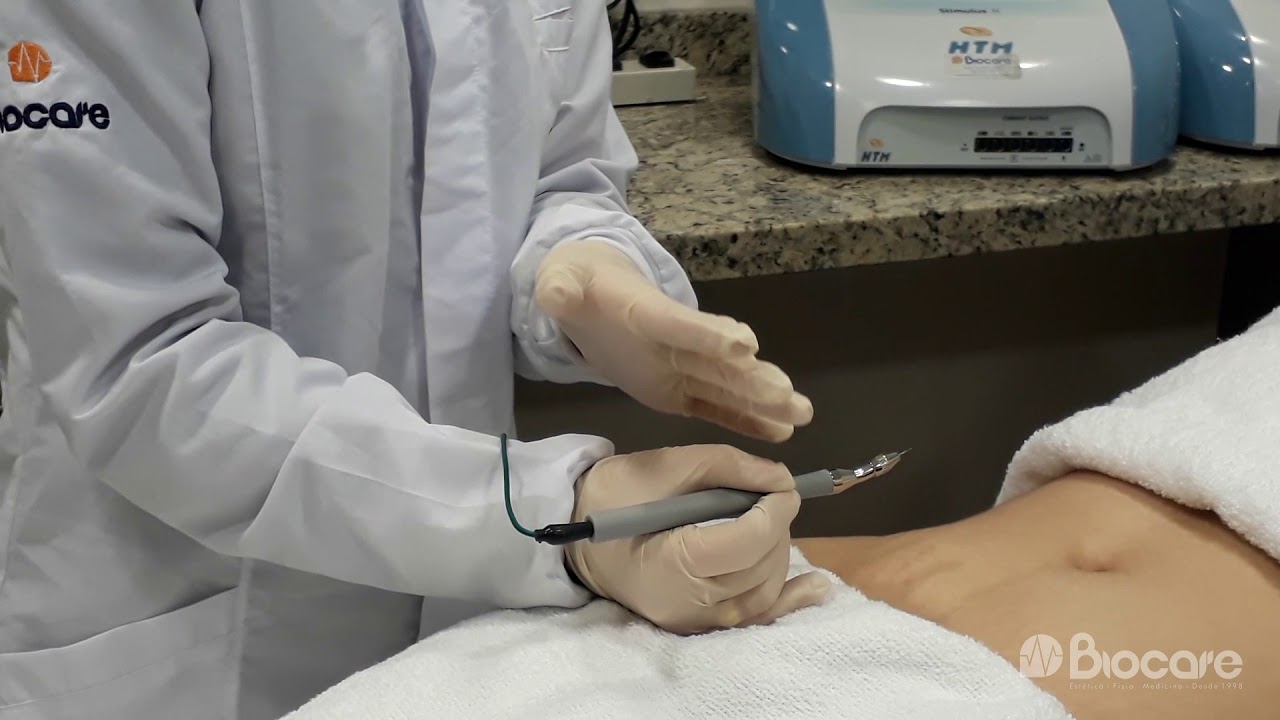 Protocolo de Microgalvanopuntura no Tratamento de estrias, com equipamento Stimulus Face HTM
