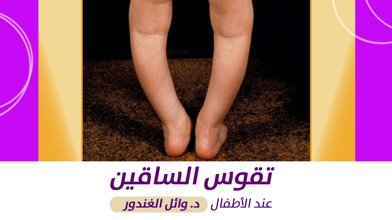 تقوس الساقين عند الاطفال مع د. وائل الغندور / مجمع أصداء الصحة