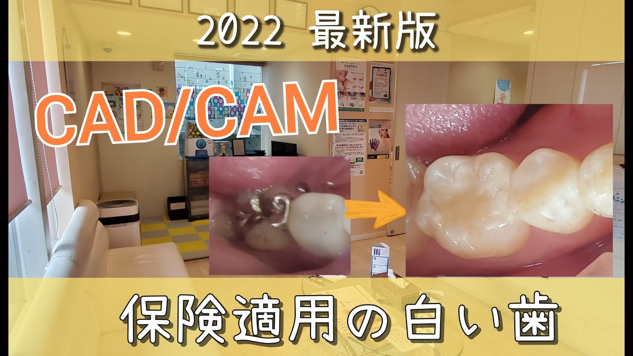 【白い歯】CAD/CAM【保険適用】