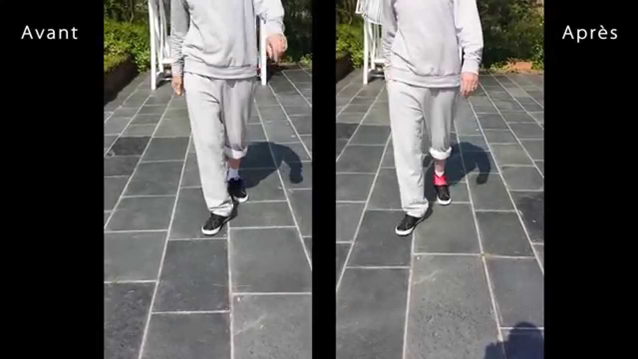 Paralysie des releveurs du pied - Effets des sangles Kinépod
