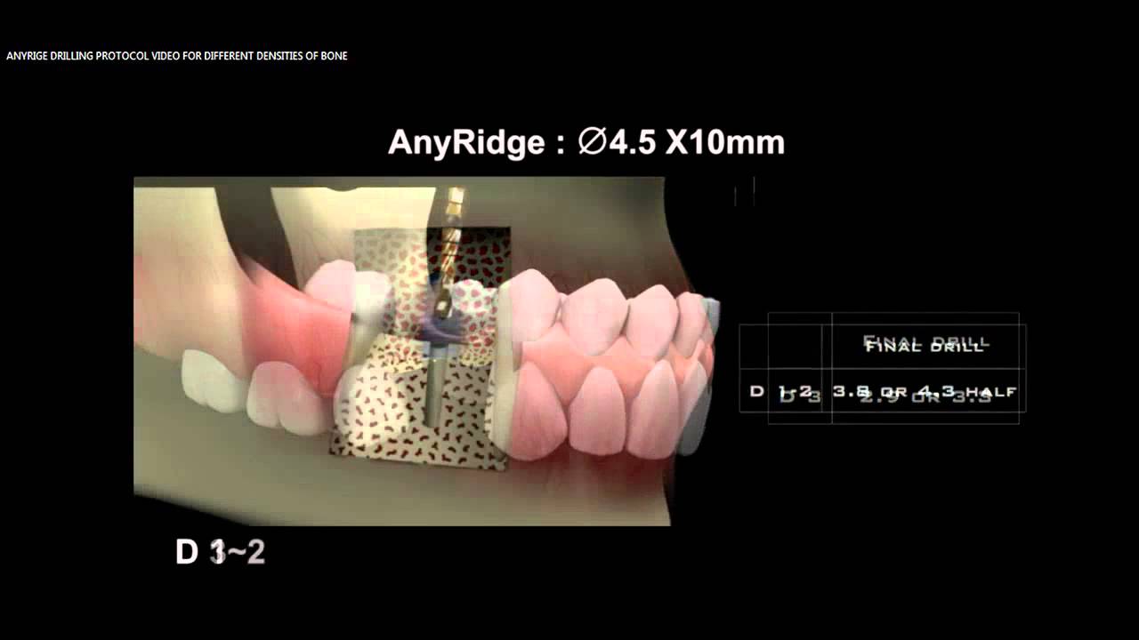 AnyRidge Drilling Guide of 4 5 x 10 in D1 D5 Bone Narrated