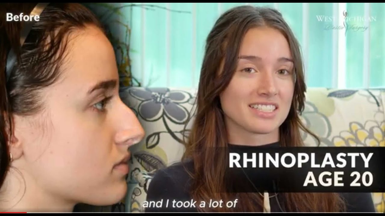 Rhinoplasty - My Story
