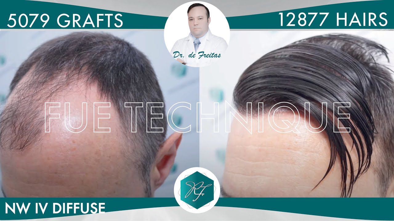 Injerto Capilar Técnica FUE – 5.079 Grafts (12.877 Pelos) – Dr. Rafael de Freitas