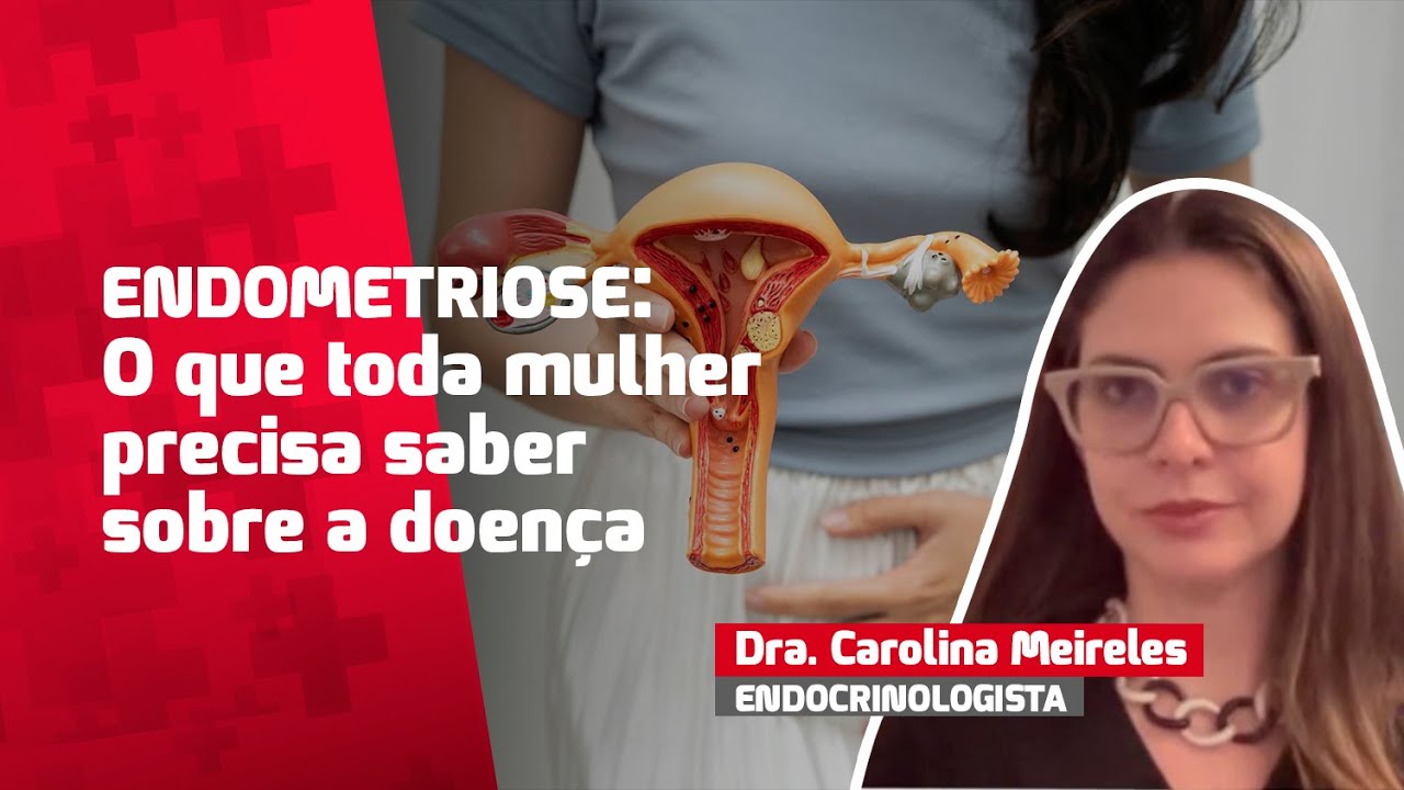 Endometriose: o que toda mulher precisa saber
