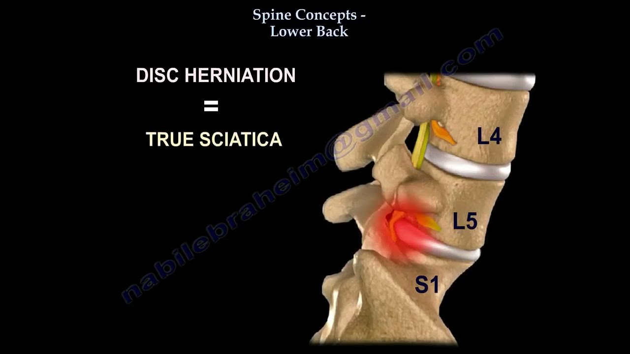 Low Back pain. Lumbar disc herniation, causes ,diagnosis ,symptoms and treatment