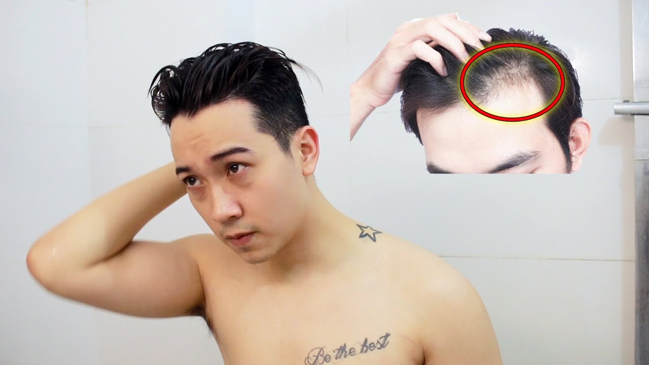 Nguyên nhân gây RỤNG TÓC - HÓI ĐẦU || Cách giảm rụng tóc hiệu quả ! Huy Quốc