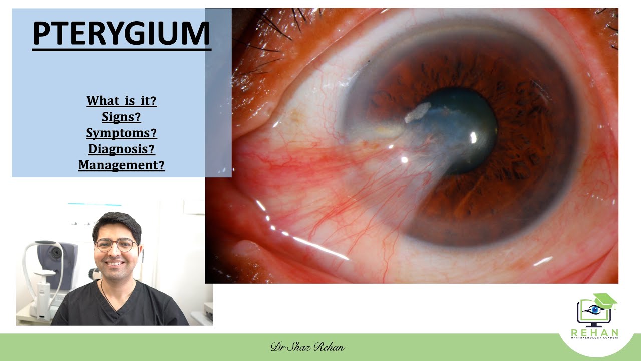 Pterygium: What is it? Signs? Symptoms? Diagnosis? Treatment? I Dr Shaz Rehan, 2021