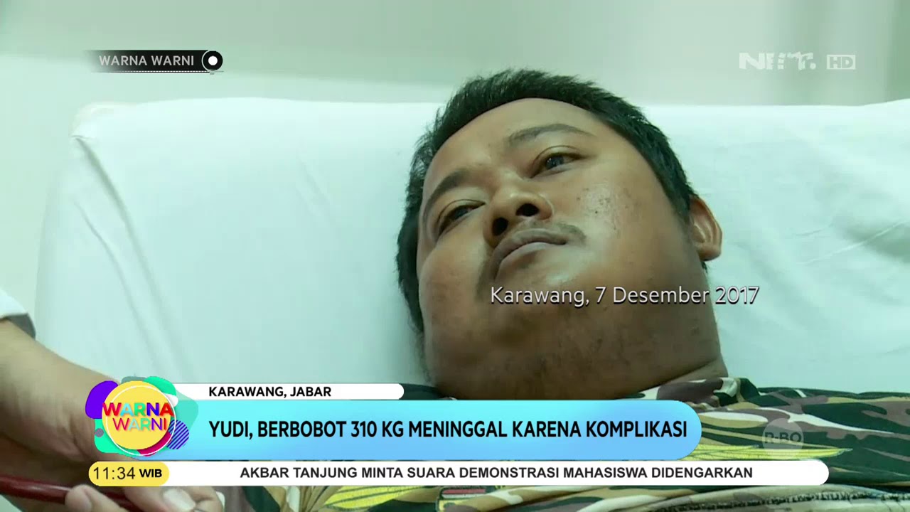 Kasus Obesitas di Karawang