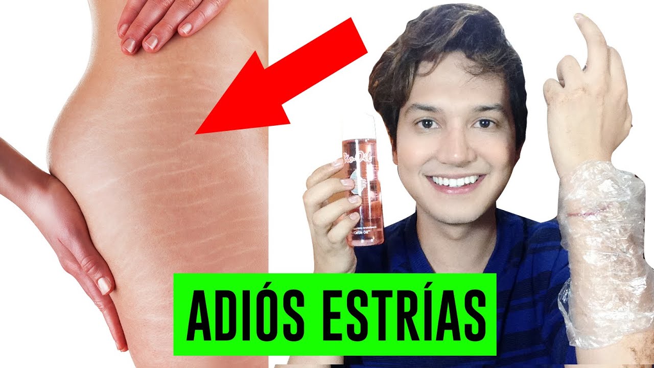 COMO ELIMINAR LAS ESTRIAS DEL ABDOMEN Y LOS GLUTEOS RAPIDAMENTE | Andy Zaturno
