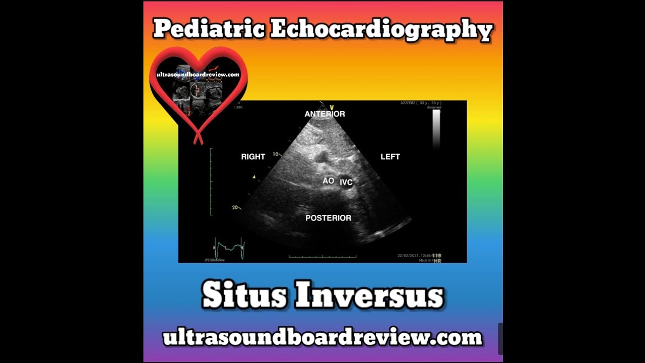 Situs Inversus