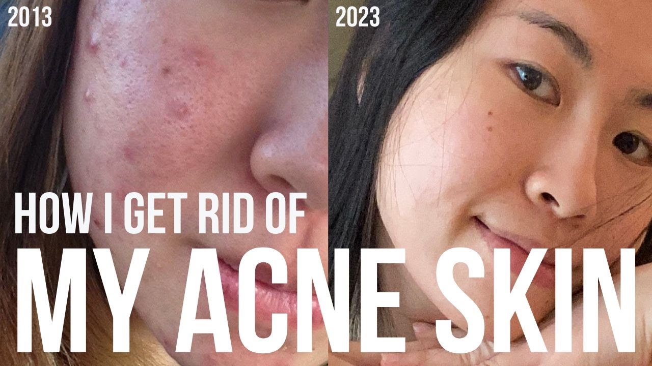 How I GET RID of my acne skin | 爛臉拯救計畫之心酸抗痘史