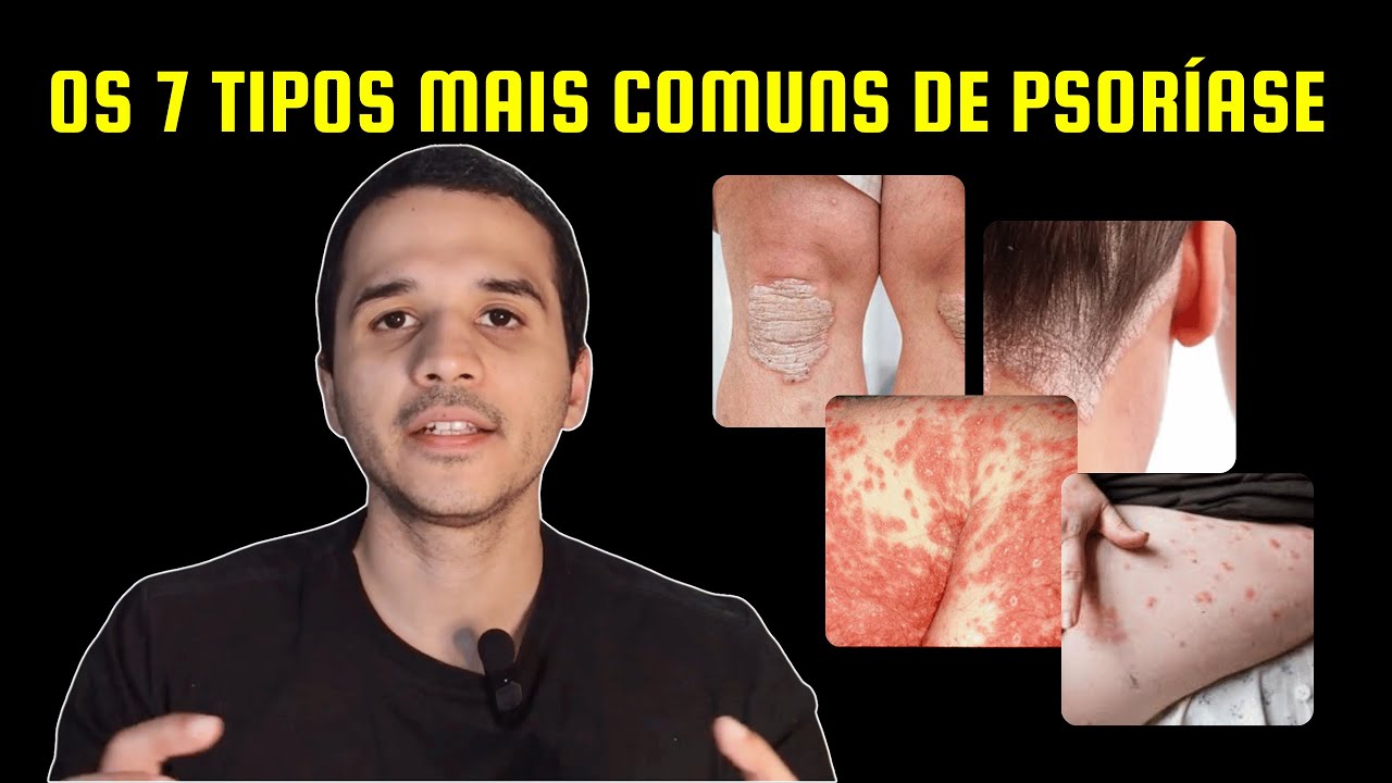 Tipos de Psoríase: Conheça os 7 Principais e Seus Sintomas (Dermatologista Explica)