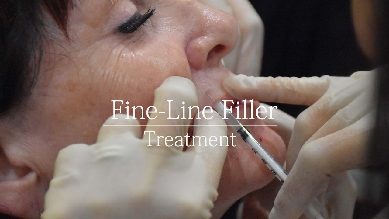 Fine Line Dermal Filler - treatment video