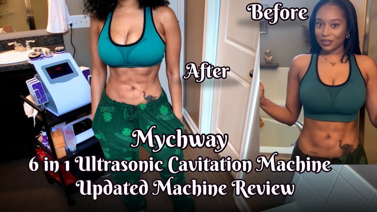 Прогресс за 6 месяцев: до и после | Аппарат ультразвуковой кавитации Mychway 6 в 1 | Чёрная пятни...