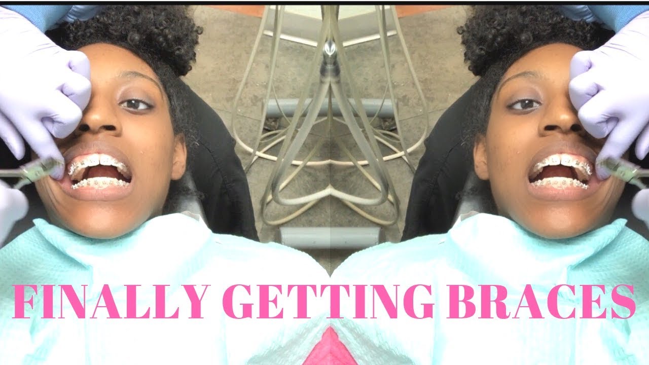 I FINALLY got my braces! | Full procedure braces vlog