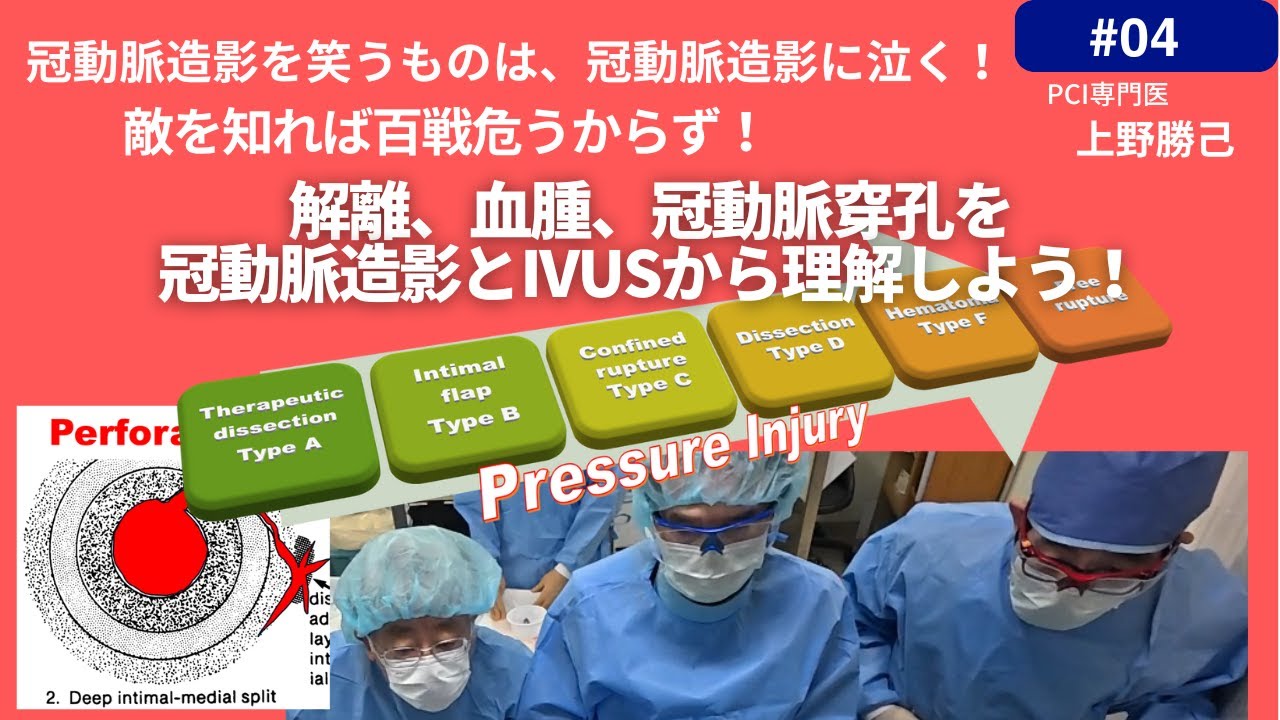 第4回 冠動脈造影を笑うものは冠動脈造影に泣く！敵を知れば百戦危うからず ！ 解離、血腫、冠動脈穿孔を冠動脈造影とIVUSから理解しよう！