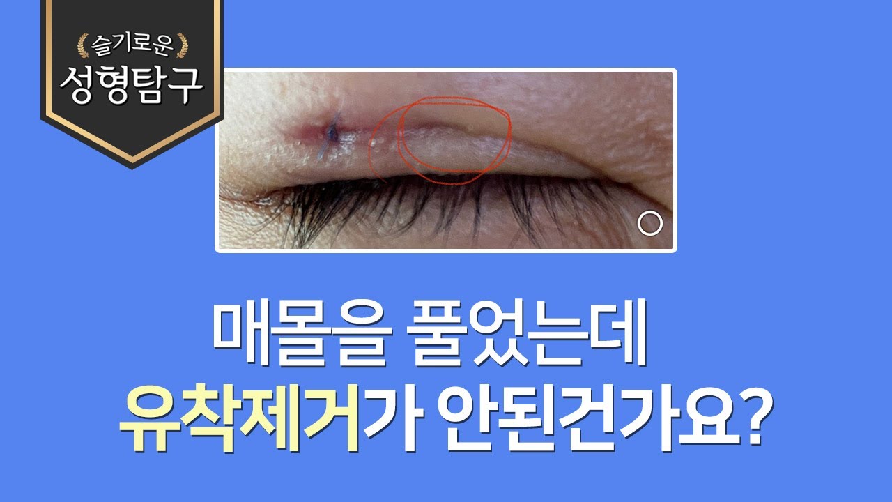 Q. 매몰을 풀었습니다. 라인 부분이 쏙 들어가는데 유착 제거가 안된건가요?