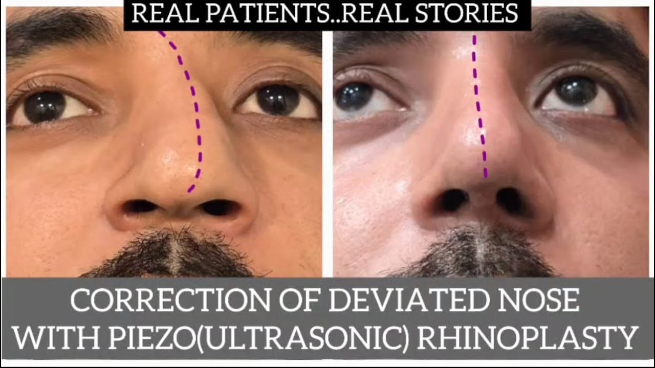 REAL PATIENTS & REAL STORIES | Rhinoplasty | Skin-n-Shape | Dr. HS Bakshi