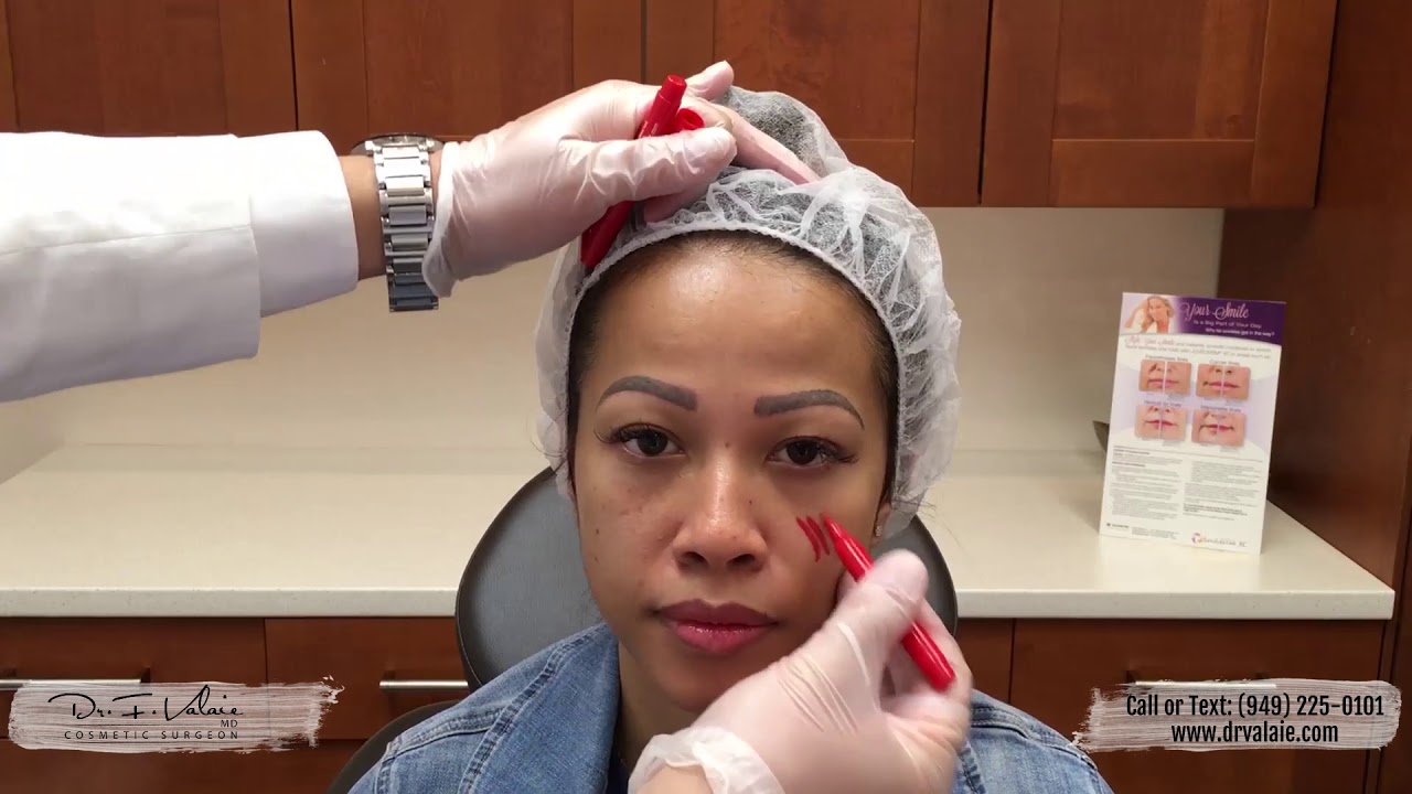 Cheek Augmentation Video - Dr. Valaie, MD - Newport Beach, Orange County (OC), CA