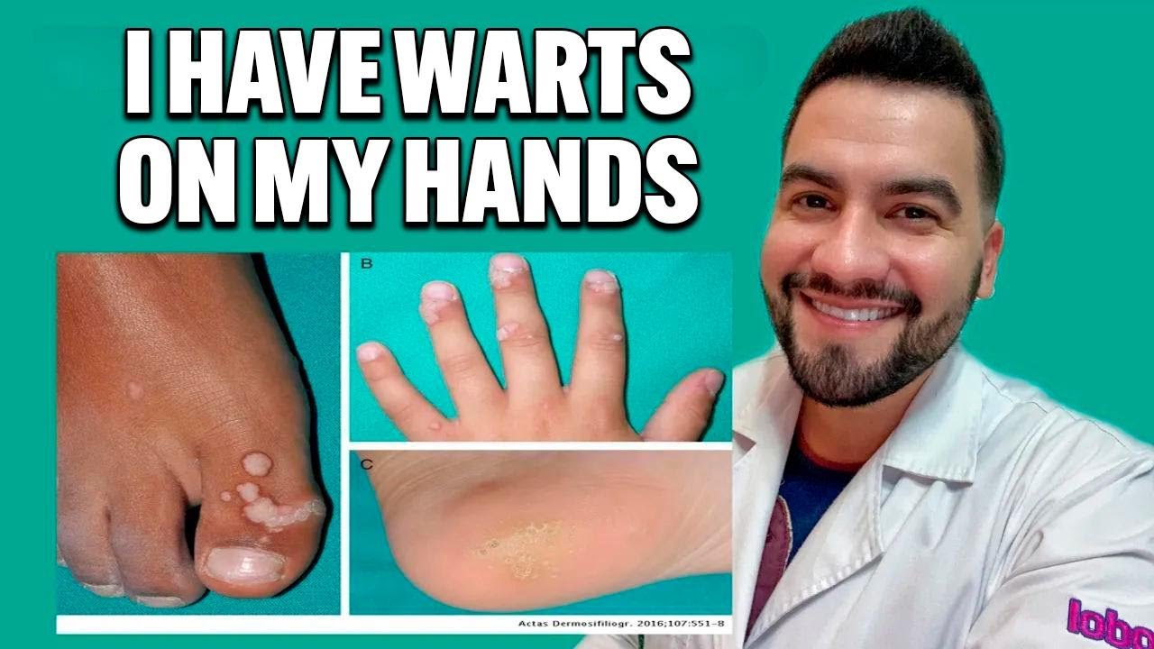 I've Got Warts on My Hand! | Common & Plantar Warts Explained | Dr. David Campos