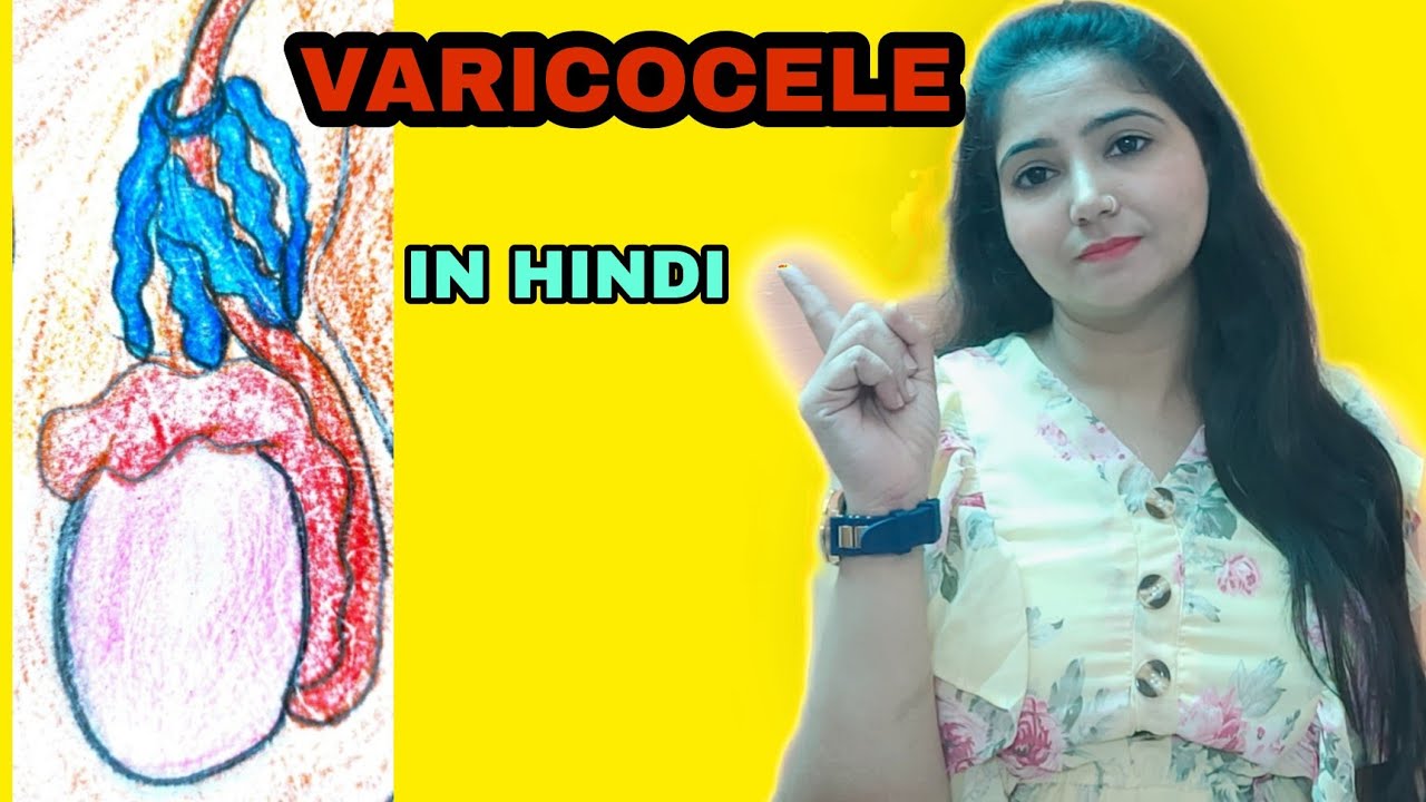 VARICOCELE | varicocele treatment | In hindi | @studywithmeekta