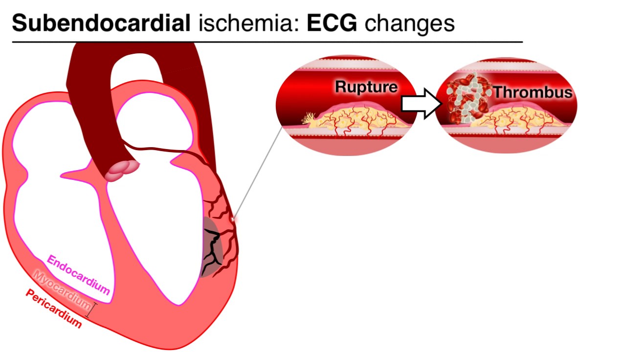 Ischemia 4/7 - UA and NTSEMI