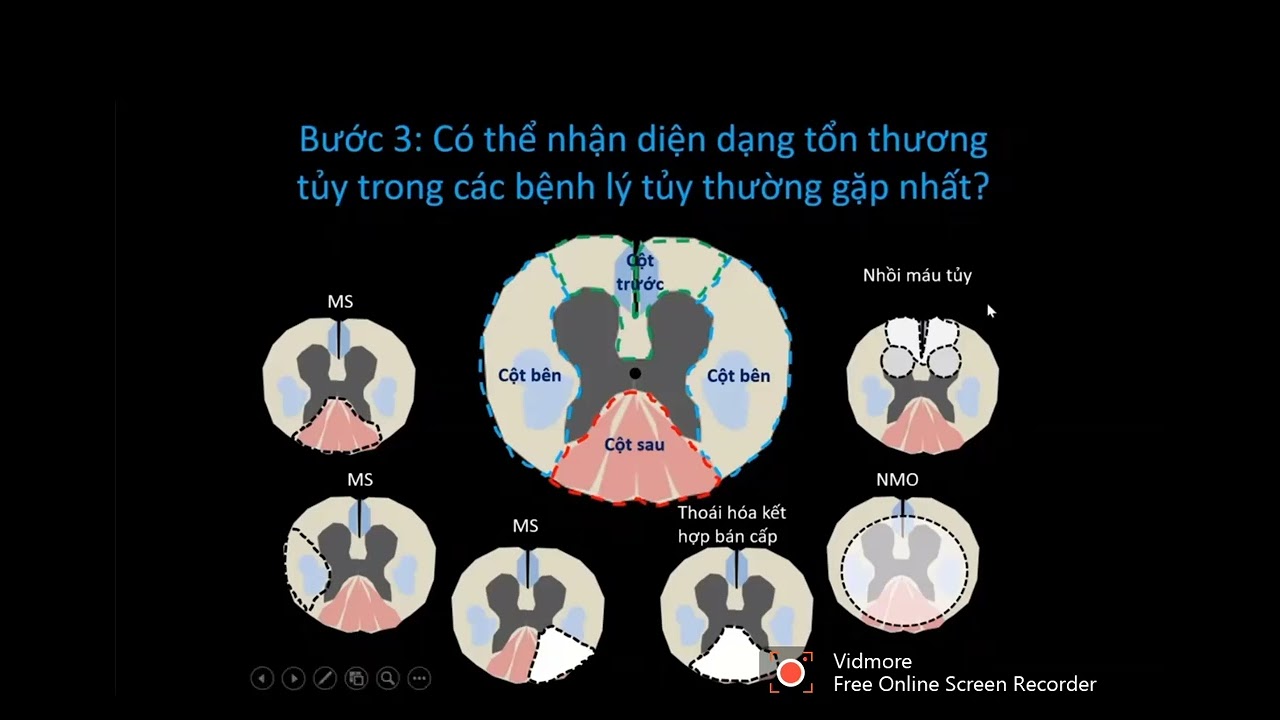 Hình ảnh u cột sống, ống sống và các bệnh lý tủy | BSCKII. Cao Thiên Tượng