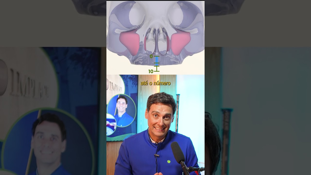 &Eacute; poss&iacute;vel n&atilde;o ter osso para fazer o implante zigom&aacute;tico? - Implace Implantes
