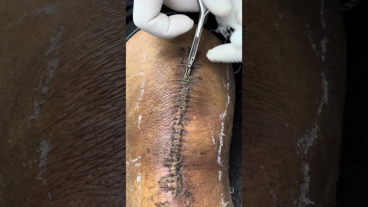 Skin Staple Sutures Removal Technique