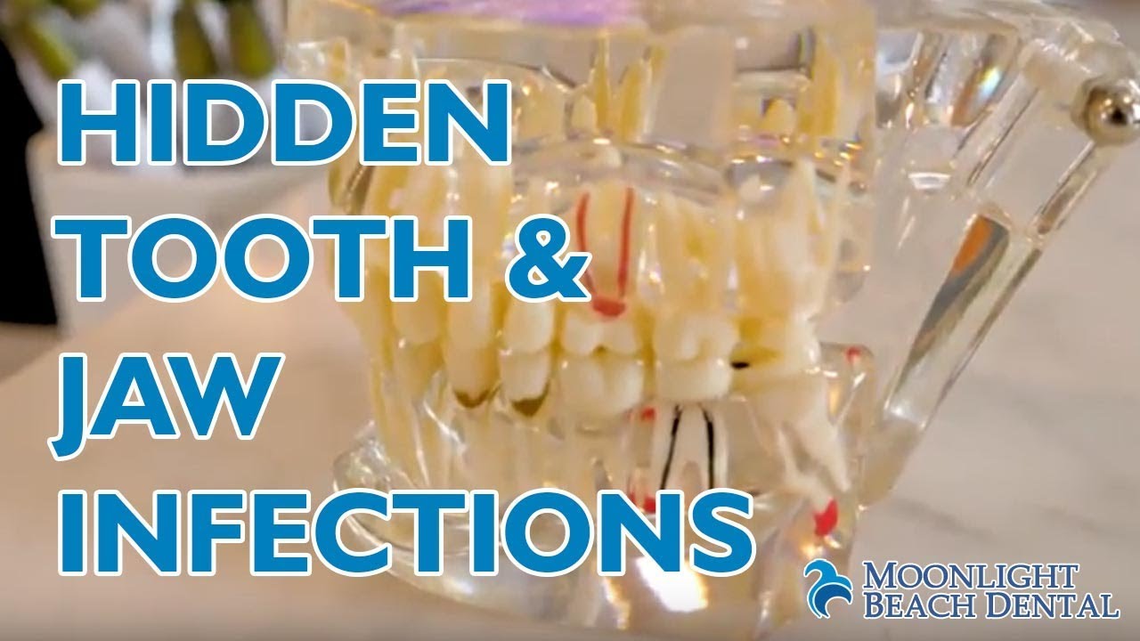 Hidden Tooth & Jaw Infections