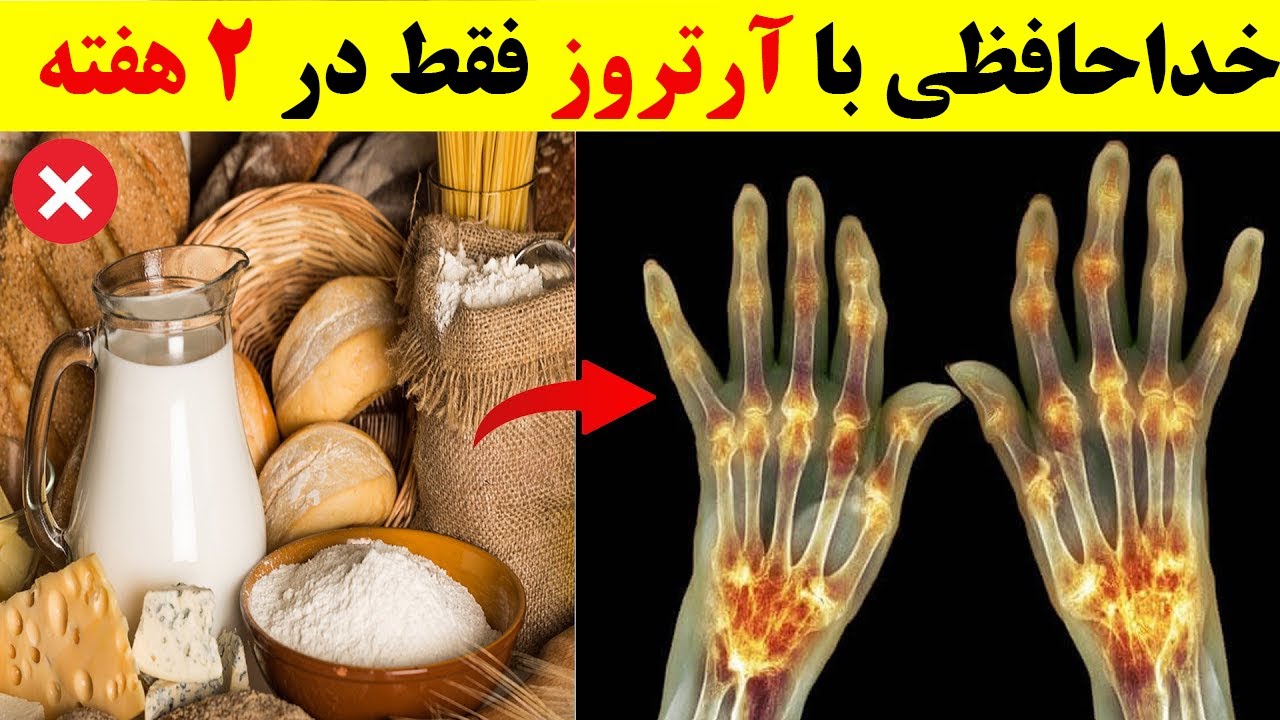 ۹ غذایی که اگر آرتروز دارید باید از آنها دوری کنید ❌درمان قطعی و ریشه ای با انتخاب غذاهای درست✅