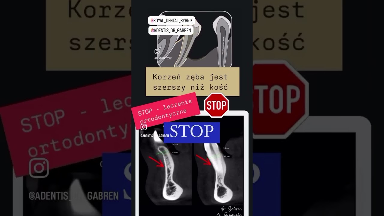 Paradontoza. Nowe możliwości dla RATOWANIA Twoich zęb&oacute;w🆘🆘🆘
