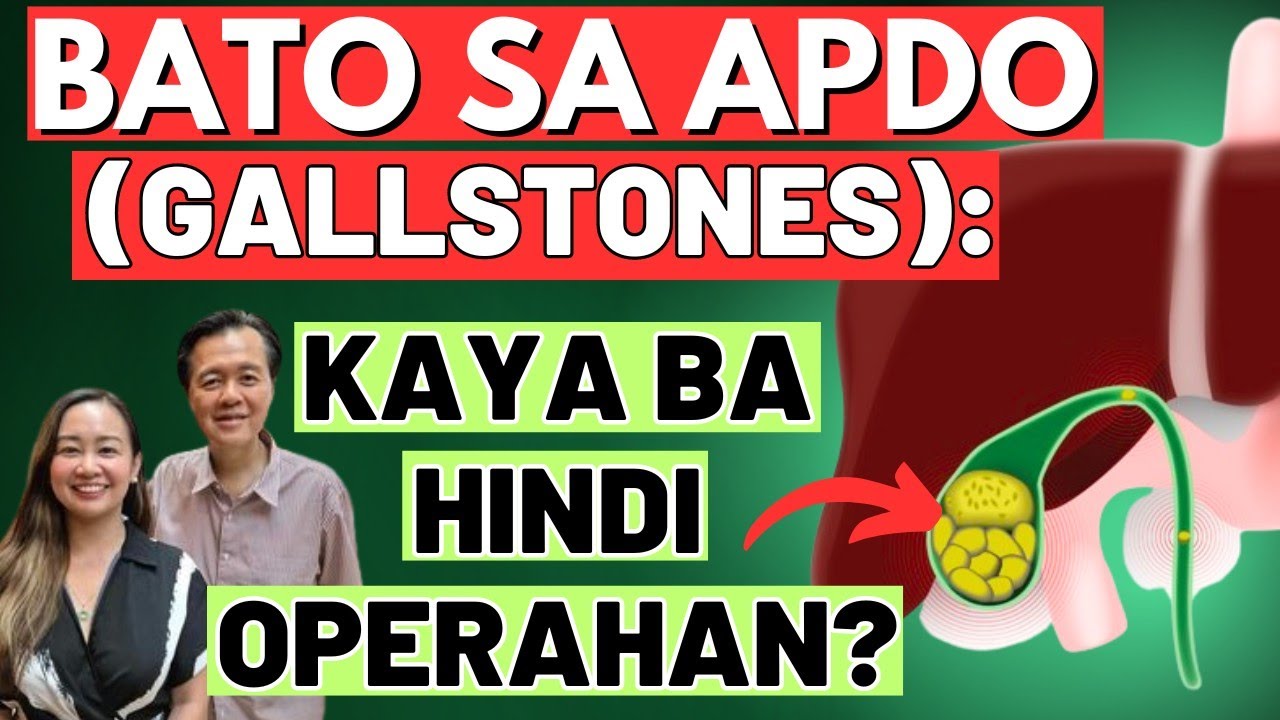 Bato sa Apdo (Gallstones): Kaya Ba Hindi Operahan? - By Doc Willie Ong