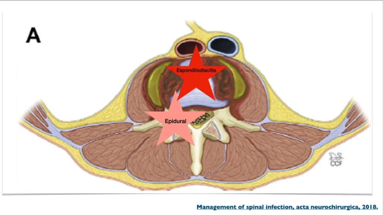 Espondilodiscitis. Dr Esteban Vallejo