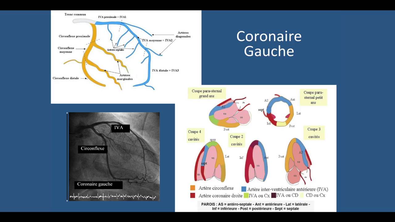 Coronarographie et Angioplastie coronaire