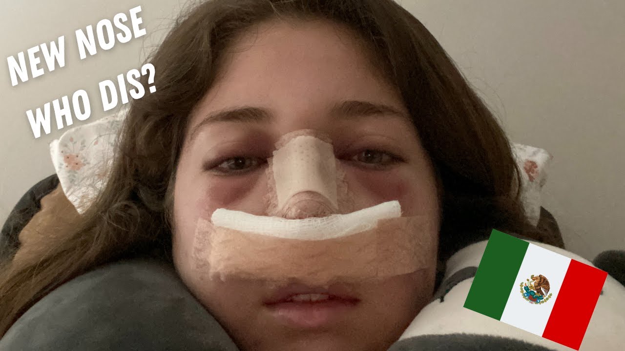 I GOT A NOSE JOB IN MEXICO (experience, recovery, before and after!!)