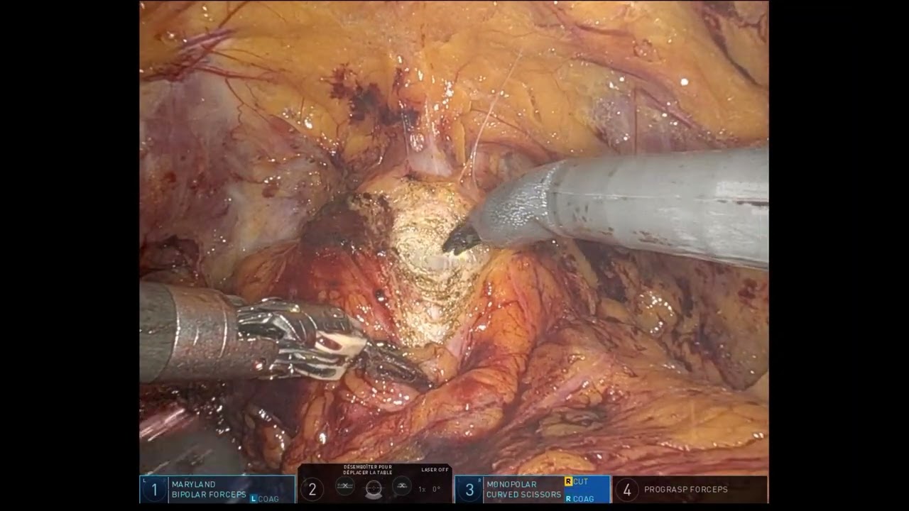 Robotic Psoas Hitch for complex ureteral stricture