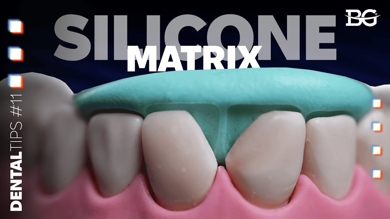 Silicone index technique for tooth restorations