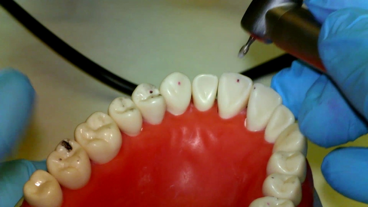 Occlusal Equilibration