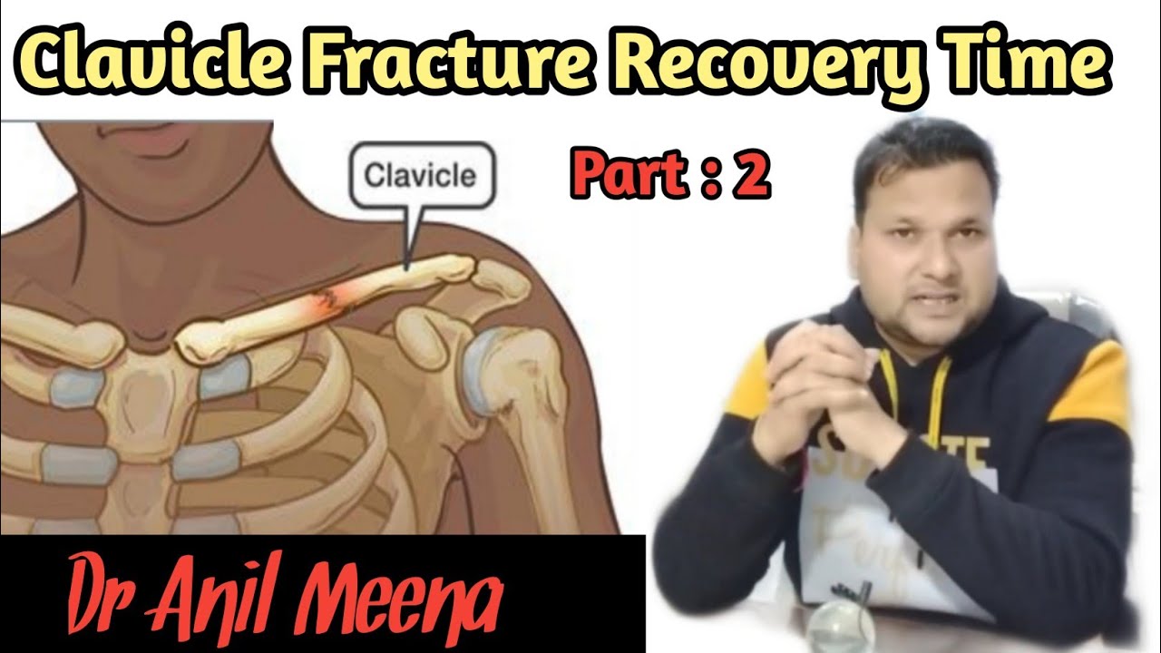 Clavicle bone fracture recovery time | clavicle bone Fracture treatment | collar bone | in hindi