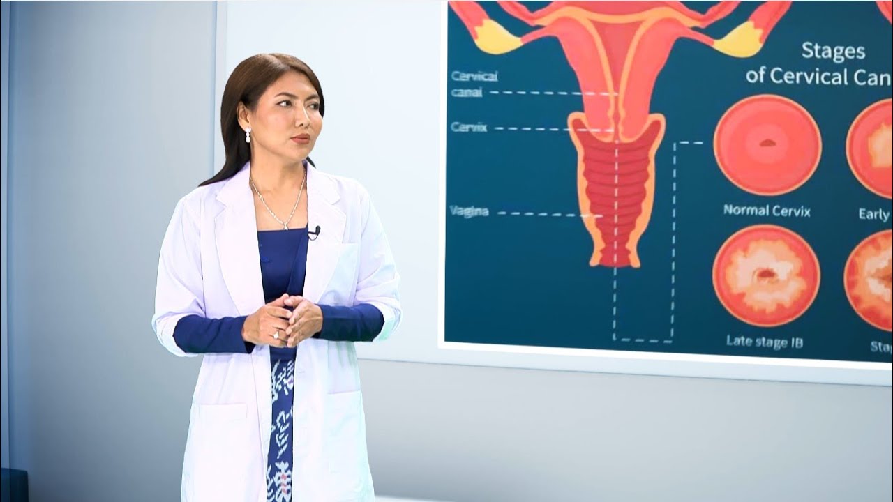 သားအိမ်ခေါင်းကင်ဆာ အကြိုအဆင့်(၂) | Health Fix | MRTV-4